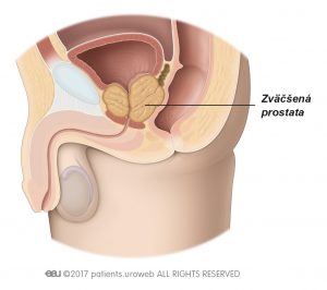 Obr. 2: Zväčšená prostata utláčajúca močovú trubicu a mechúr.