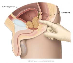 Obr. 1: Vyšetrenie per rectum na posúdenie veľkosti, tvaru a štruktúry prostaty.