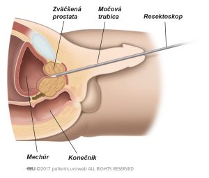 Obr. 1: Operácia cez močovú trubicu.