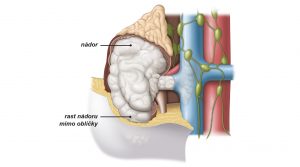Obr. 3: Štádium III – nádory sa rozšírili do obličkovej žily, tukového tkaniva v okolí obličky (perirenálny tuk) alebo dutej žily.