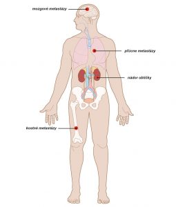 Obr. 5: Metastatická rakovina obličky sa šíri do pľúc, kostí alebo mozgu.