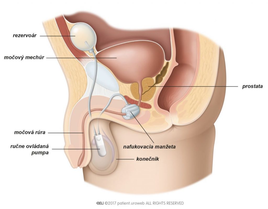 Obr. 1: Implantácia umelého močového zvierača (AUS) u muža.