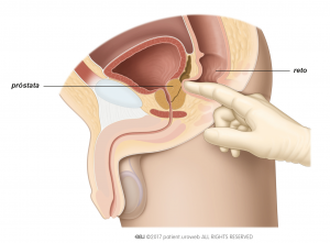 Obr. 1: Vyšetrenie prostaty pohmatom cez konečník na posúdenie veľkosti, tvaru a konzistencie prostaty.