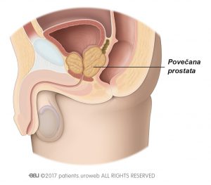 Slika 1b: Povečana prostata pritiska na sečnico in mehur.