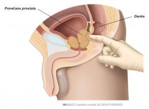 Slika 1: Digitalni rektalni pregled, s katerim ocenimo velikost, obliko in čvrstost prostate.