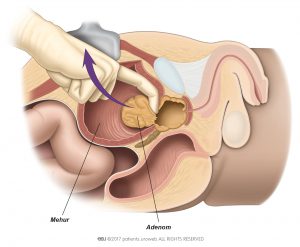 Slika 1: Kirurg med odprto prostatektomijo odstrani adenom.