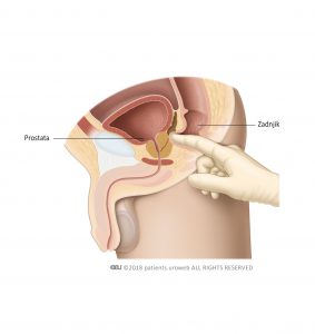 Slika 1: Rektalni pregled s prstom, da se oceni velikost, oblika in konsistenca prostate.