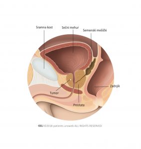 Slika 1 T1 tumor prostate je premajhen, da ga lahko zatipali med pregledom ali videli s slikovnimi preiskavami.