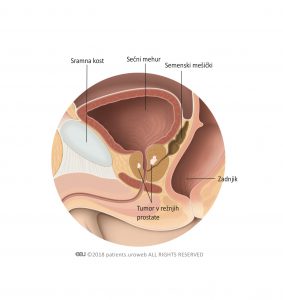 Slika 2 T2 tumor prostate je omejen na prostate.