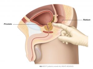 Sl. 1: Zdravnik s prstom skozi rektum otiplje velikost, obliko in čvrstost prostate.