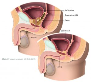 Slika 1a: Tekom radikalne prostatektomijo kirurg odstrani celotno prostate in semenske mešičke. Slika 1b: Položaj sečnega mehurja po operaciji.