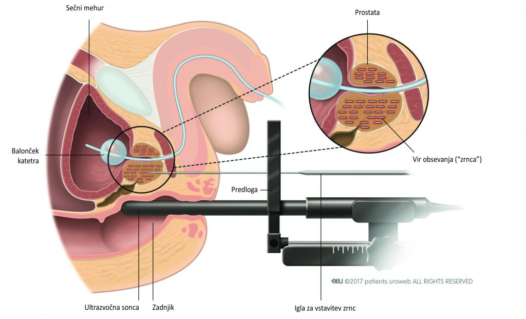 Slika 2: Pri brahiterapiji je izvor sevanja vstavljen direktno v prostato.