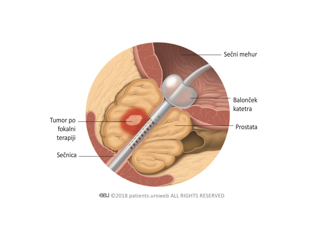 Slika 3: Pri fokalni terapiji so celice tumorja prostate ciljanje direktno, zato ni veliko poškod obolnega tkiva.