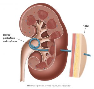 Slika 3b: Cevka perkutane nefrostome znotraj ledvice.