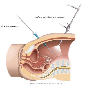 Sl. 2: Pri laparoskopski operaciji kirurg vstavi instrumente skozi majhne zareze na trebušni steni.