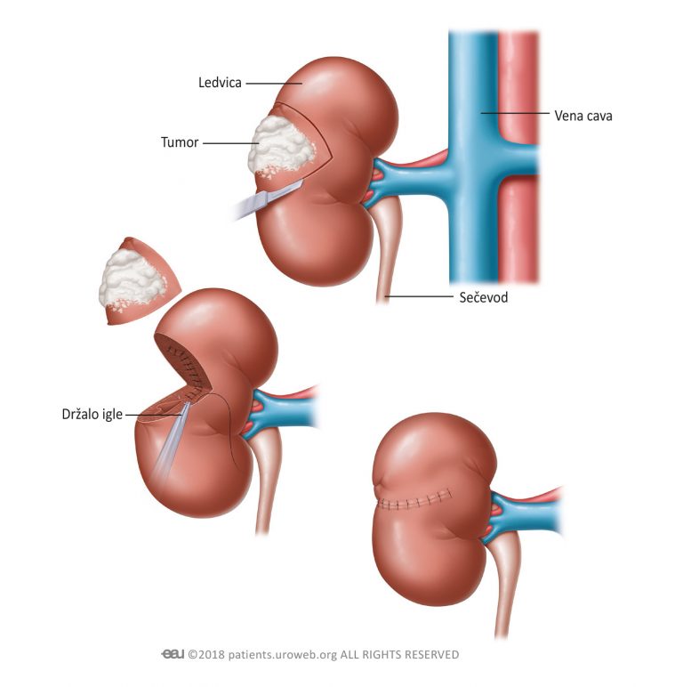 PI_Varicocele.indd - PI SL