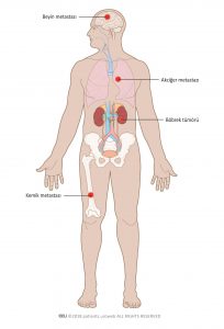 Şekil 1: Metastatik böbrek kanseri akciğerlere, kemik ve beyne yayılabilir.