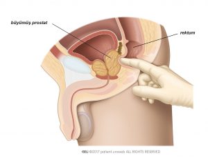 Şekil. 1: Prostatın boyut, şekil ve kıvamını hissetmek için parmakla rektal muyanesi yapılır.