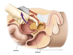 Şekil 1: Açık prostatektomi sırasında cerrah adenomu çıkarır.