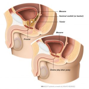 Şekil 1a: Radikal prostatektomi (prostat ameliyatı) sırasında prostat ve seminal veziküllerin kaldırılması. Şekil 1b: Ameliyat sonrası mesanenin pozisyonu.