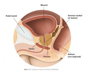 Şekil 1: Prostat tümörü muayenede hissetmek veya görüntüleme tetkiklerinde saptamak için çok küçük.