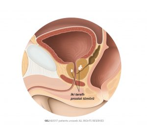 Şekil 2: Prostat tümörü prostatla sınırlıdır.