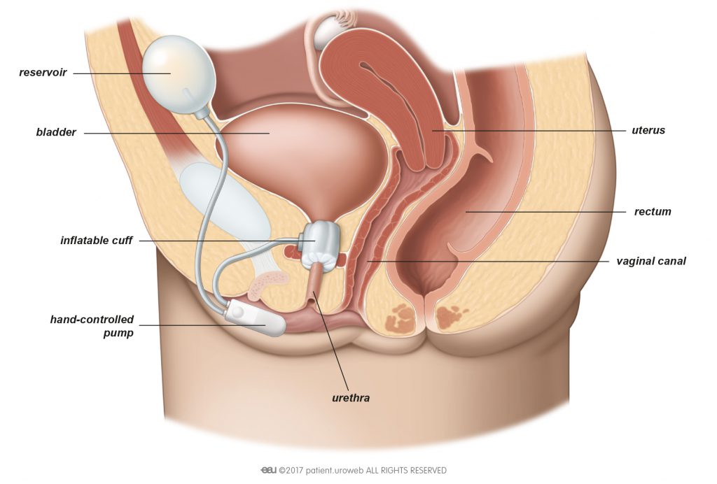 Fig.1: AUS implantation in the female lower urinary tract.