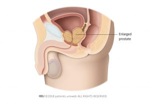 Fig. 2: An enlarged prostate compressing the urethra and bladder.