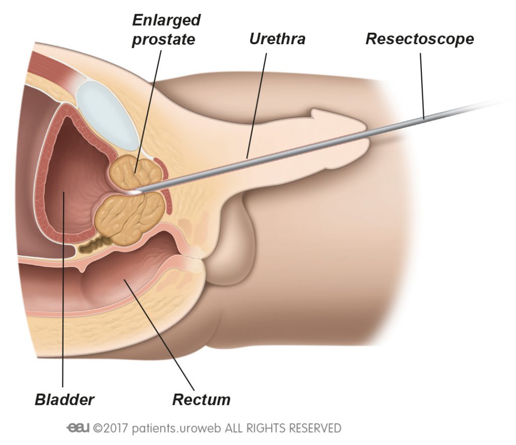 laser surgery for enlarged prostate