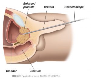 Fig. 1: Surgery through the urethra.