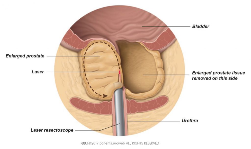 suites énucléation laser prostate prostate adenoma diagnosis