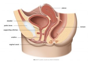 Fig. 2: In Burch colposuspension, supporting stitches lift the bladder neck.