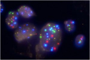 Fig. 1: Fluorescence in situ hybridization: Genetic information is highlighted by special fluorescent dyes in the nuclei of cells in the urine. Courtesy of Dr Daniel Gödde, Institute of Pathology, Helios Klinikum Wuppertal, University of Witten/Herdecke