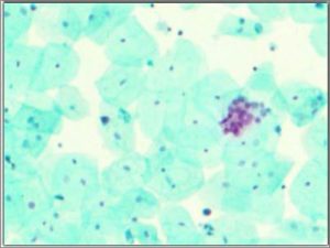 Fig. 2: A photomicrograph of normal cells (green) and cancer cells (red/pink) in the urine stained with CellDetect®. Source: A Novel Urine Cytology Stain for the Detection and Monitoring of Bladder Cancer. Noa Davis_JUrol:2014;p1628.