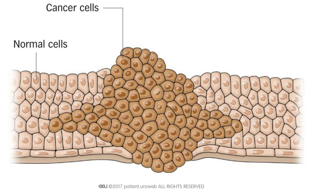 Fig. 1: Cancer cells crowding out healthy cells.