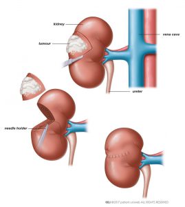 Fig. 1: In partial nephrectomy the tumour is removed, leaving as much as possible of the healthy kidney tissue.