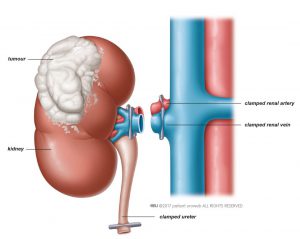 Fig. 1: The tumour is removed together with the whole kidney.