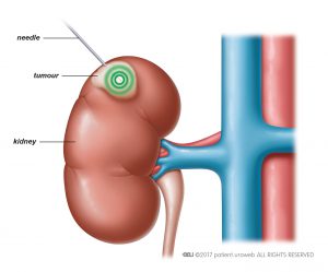 Fig. 1: Ablation therapy kills tumour cells in the kidney by either heating or freezing.