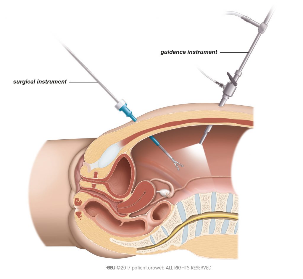 Fig. 1: For laparoscopic surgery the surgeon inserts the surgical instruments through small incisions in the abdomen.