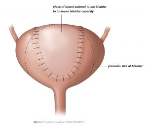 Fig. 2: Bladder surgery to increase the size of the bladder.
