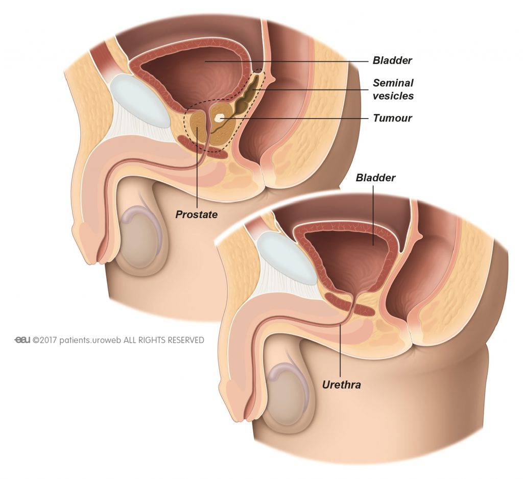 prostate removal Kőfájás a prosztatában