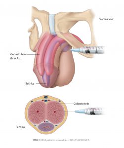 Fig.1: Intracavernous injections are a treatment option for ED.