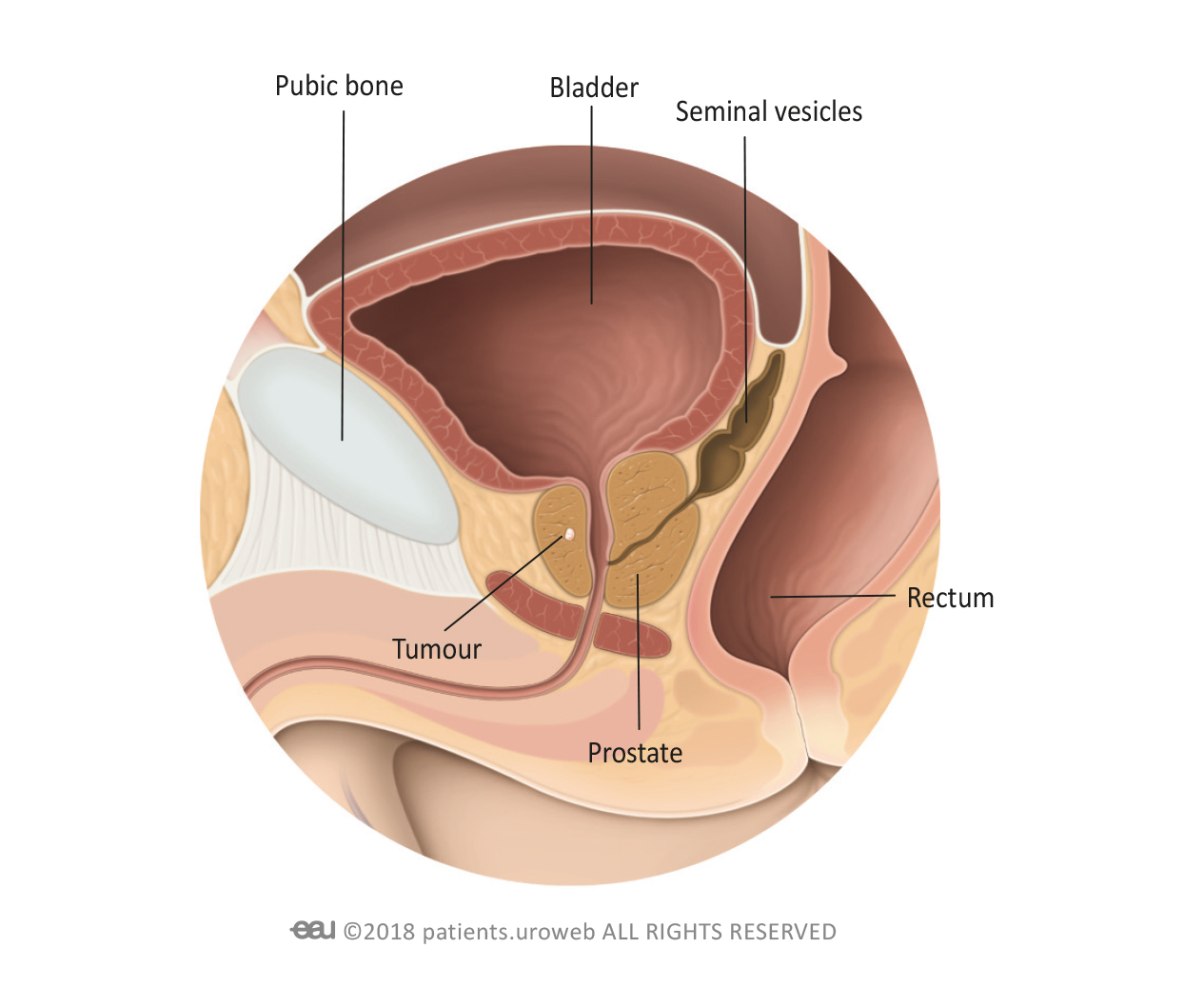 treatment-of-localised-prostate-cancer-patient-information