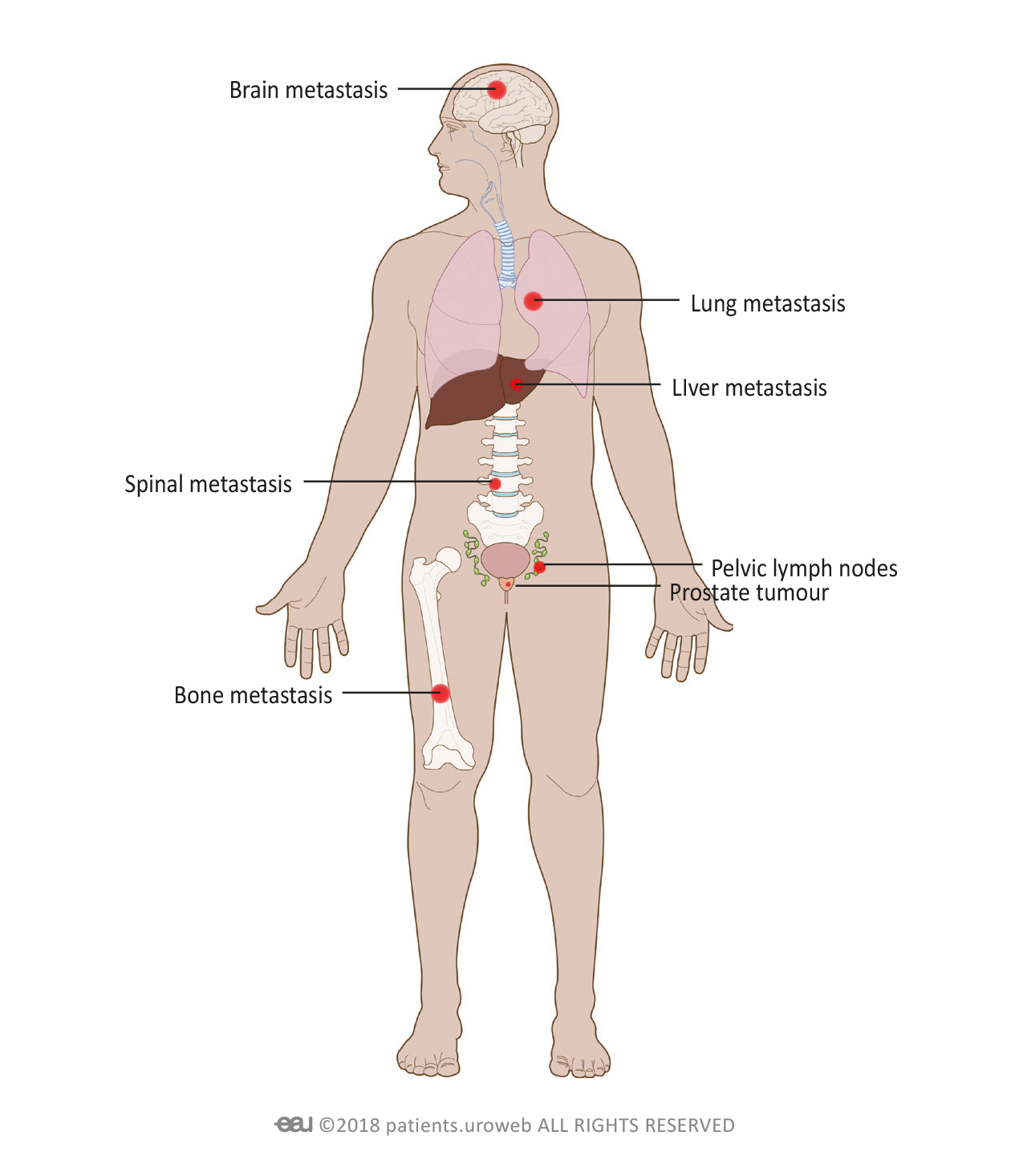 cancers-free-full-text-metastatic-prostate-cancer-a-review-of