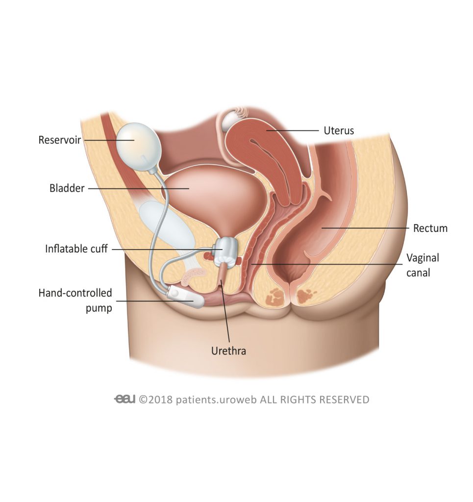 Female urethra insertion