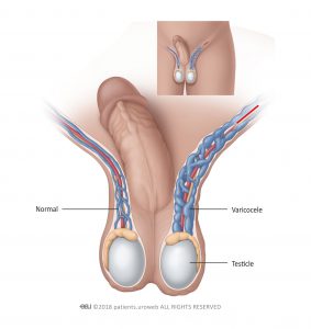 Fig. 1: varicoceles are usually found in the left side of the scrotum.