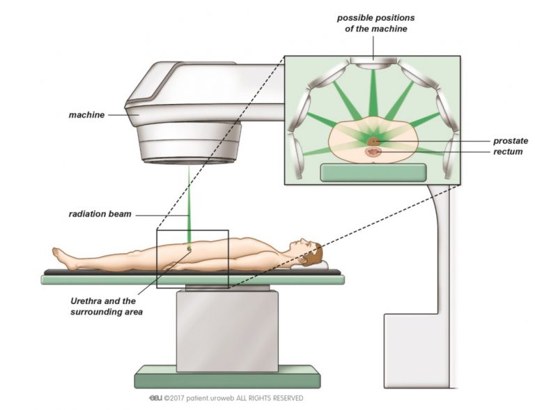 Radiation therapy Patient Information