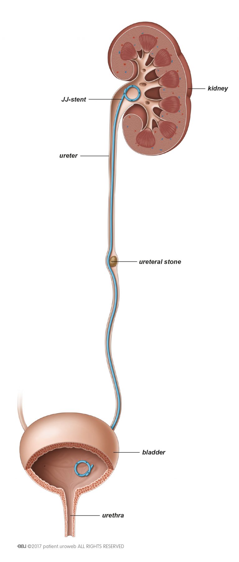 partial-nephrectomy-patient-information