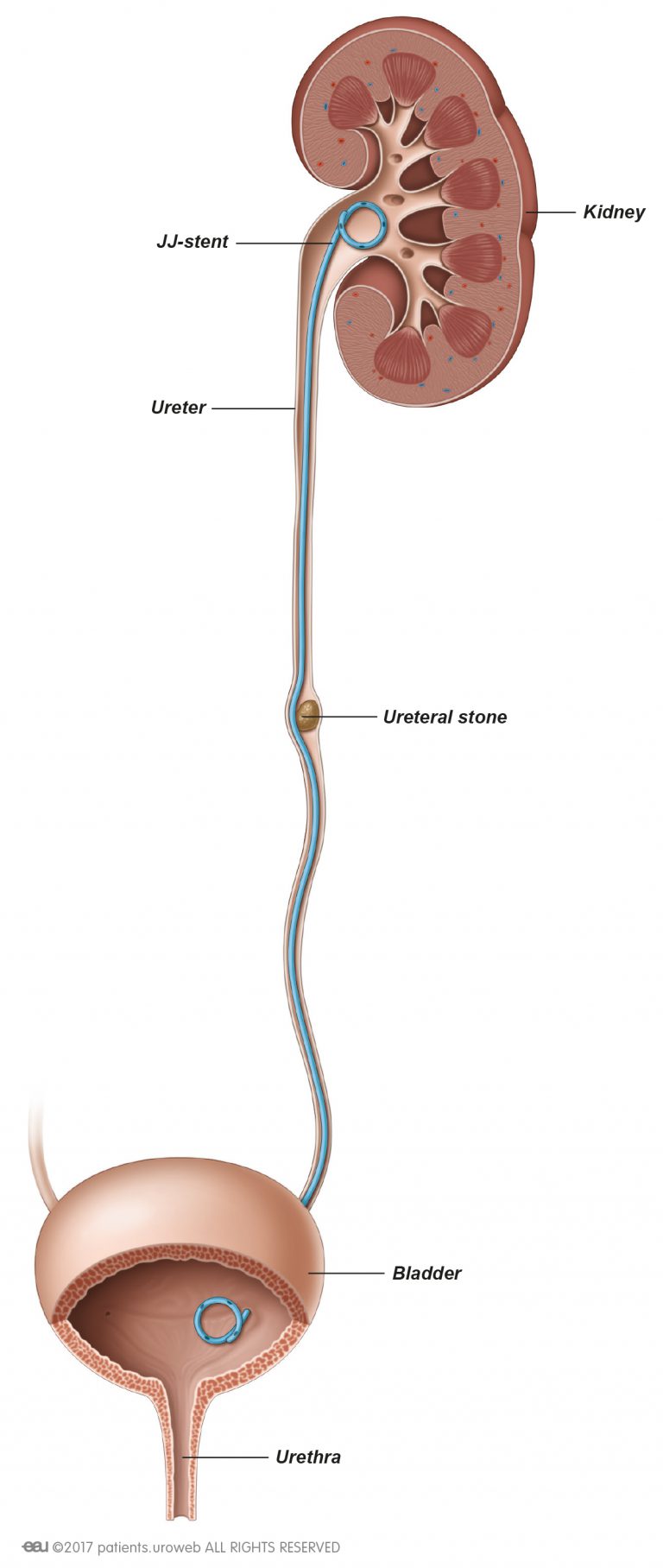 Percutaneous Nephrolithotomy (PCNL) - Patient Information