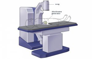 Shock Wave Lithotripsy Patient Information